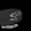 SPORK, NICO - 22.03.1976 - 02.08.2022 - CT obere Extremität - 18:02:23